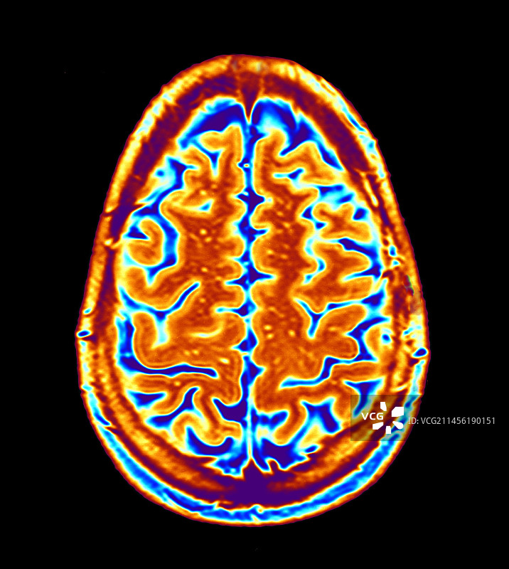 脑部扫描，核磁共振扫描图片素材