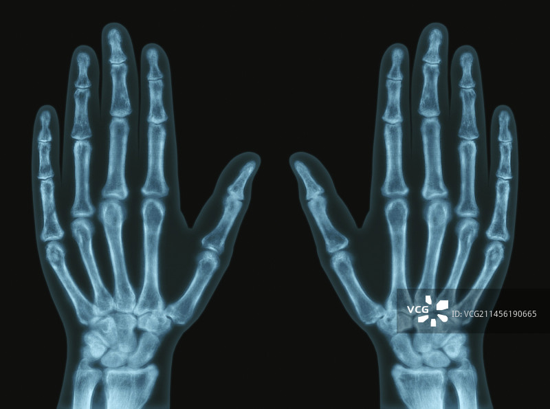 手部X光片图片素材