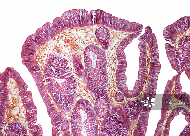 直肠乳头状瘤，光学显微照片图片素材
