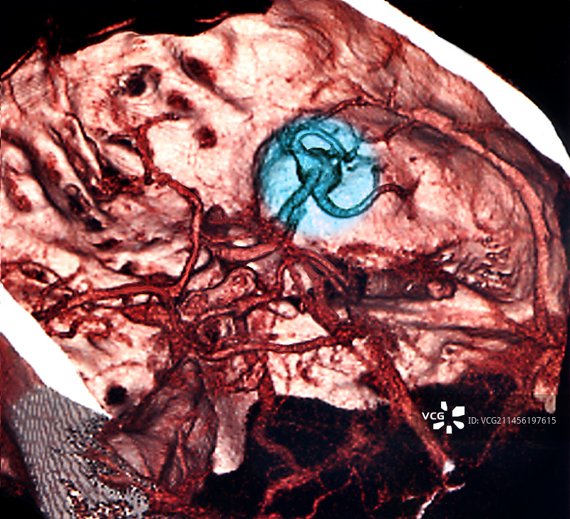 脑出血3D血管造影图图片素材