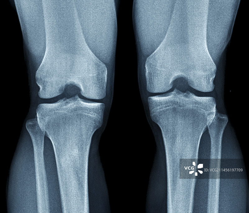 正常膝盖X光片图片素材