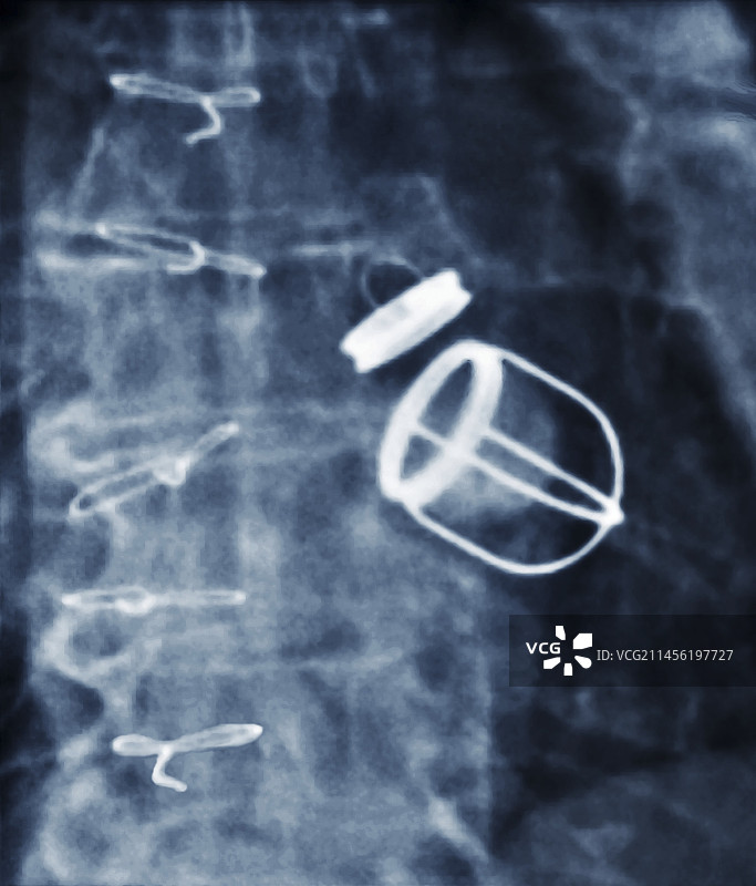 人工心脏瓣膜X光片图片素材