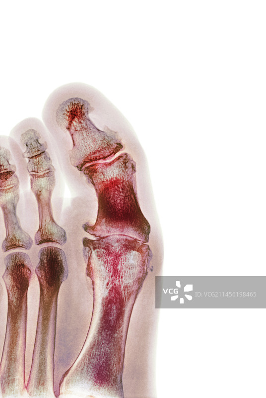 退行性足部畸形X光片图片素材