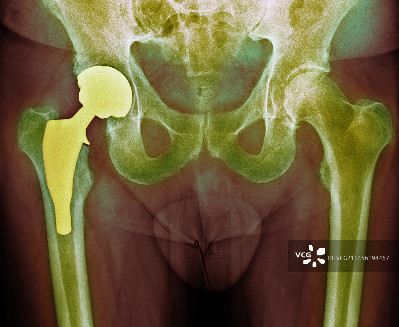 全髋关节置换X光片图片素材