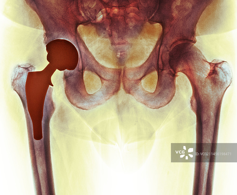 全髋关节置换X光片图片素材