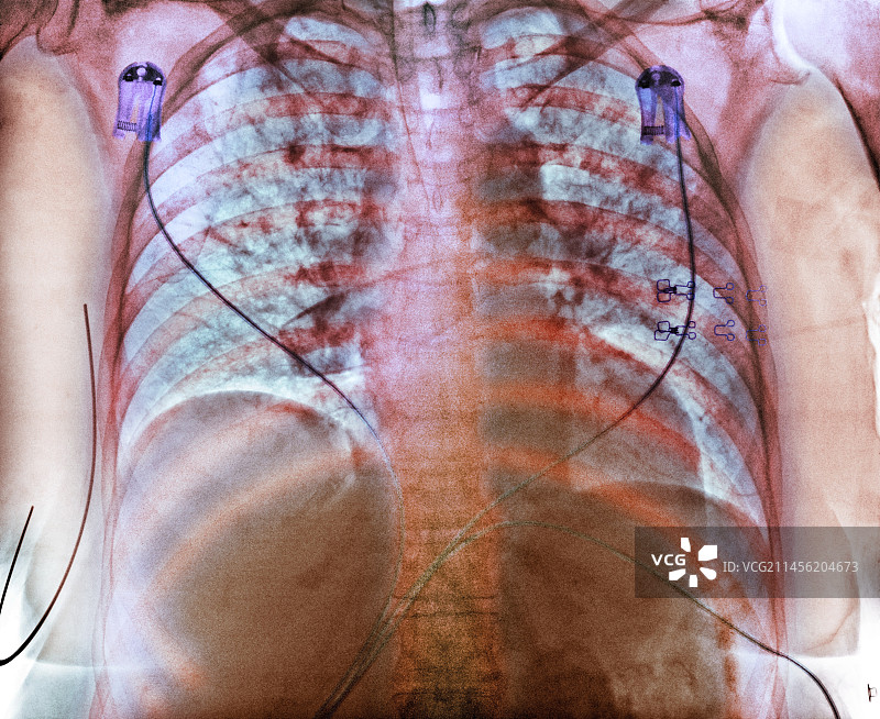 吸入性肺炎胸部X光片图片素材