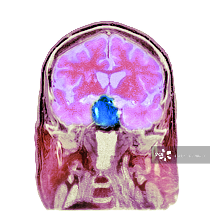 脑垂体肿瘤CT扫描图片素材