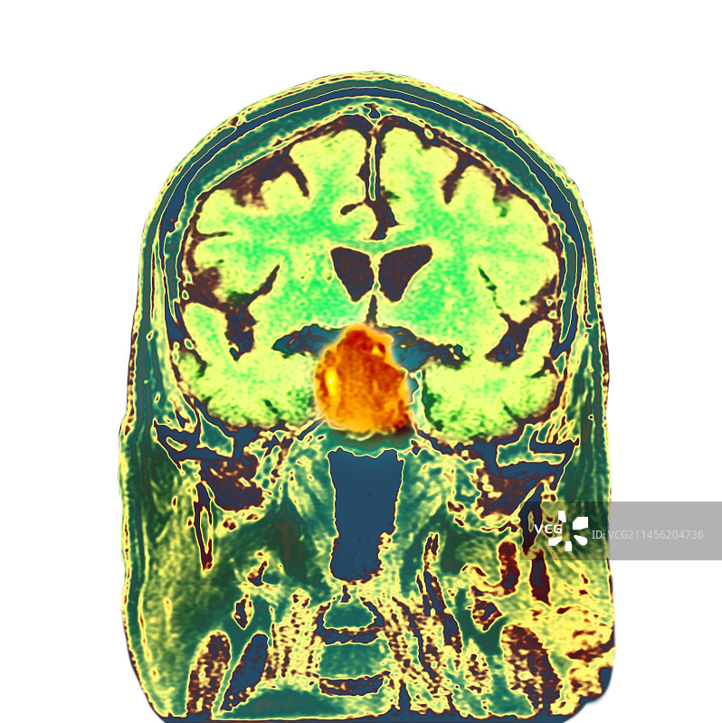 脑垂体肿瘤CT扫描图片素材