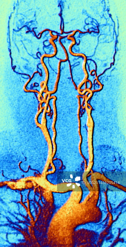 胸颈部和头部动脉MRA扫描图片素材