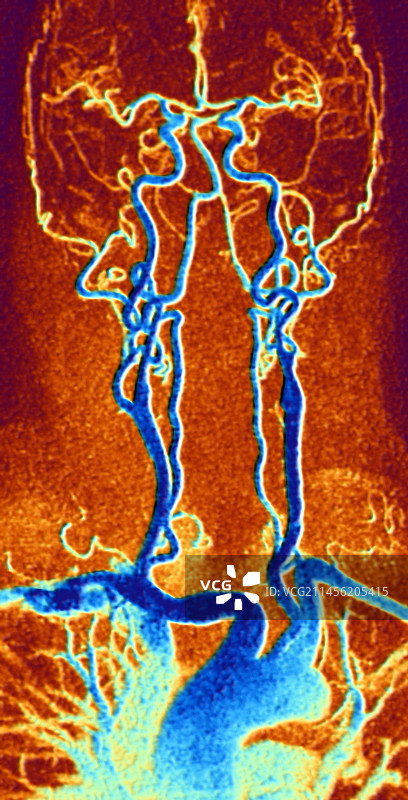 胸颈部和头部动脉MRA扫描图片素材