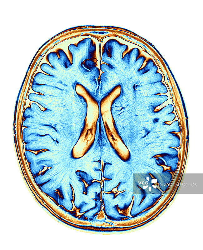 人脑核磁共振扫描图片素材