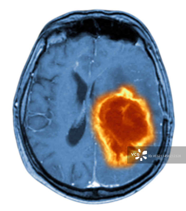 脑肿瘤插画图片素材