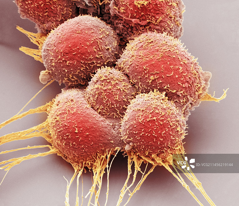 前列腺癌细胞扫描电镜图图片素材