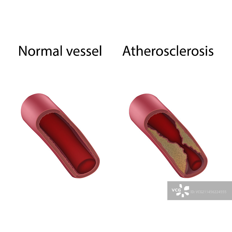 动脉粥样硬化与正常血管插图图片素材