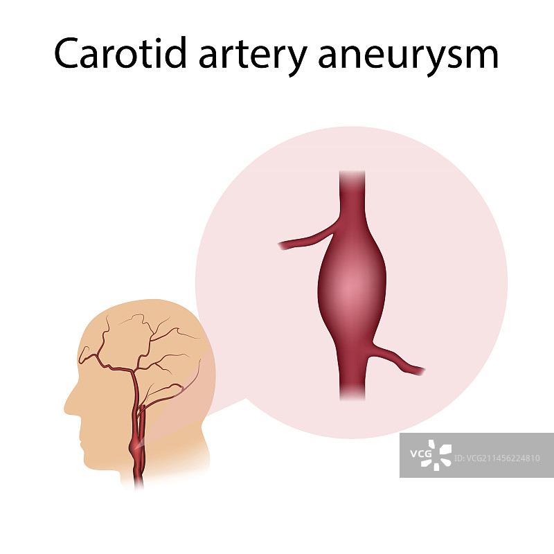 颈动脉动脉瘤插图图片素材