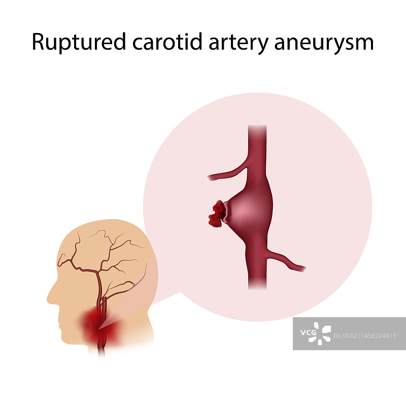 颈动脉瘤破裂示意图图片素材