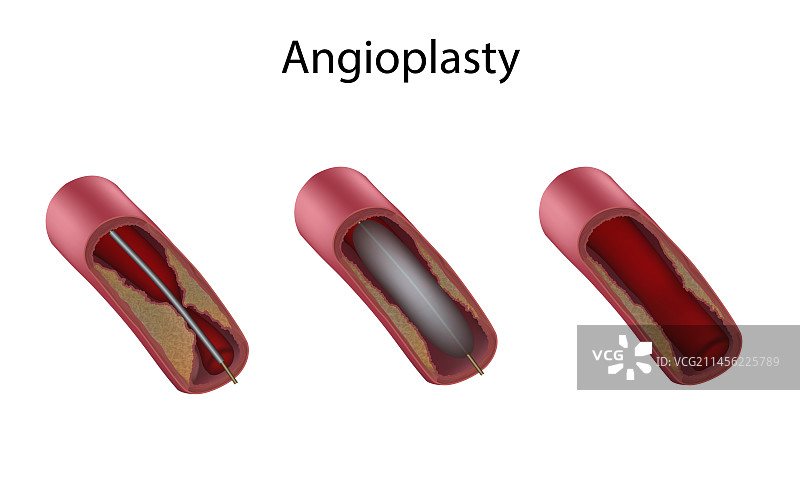 球囊血管成形术的各个阶段，图示图片素材