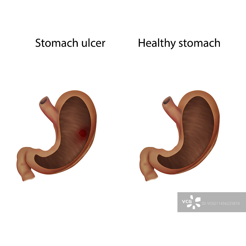 胃溃疡与健康胃部对比图图片素材