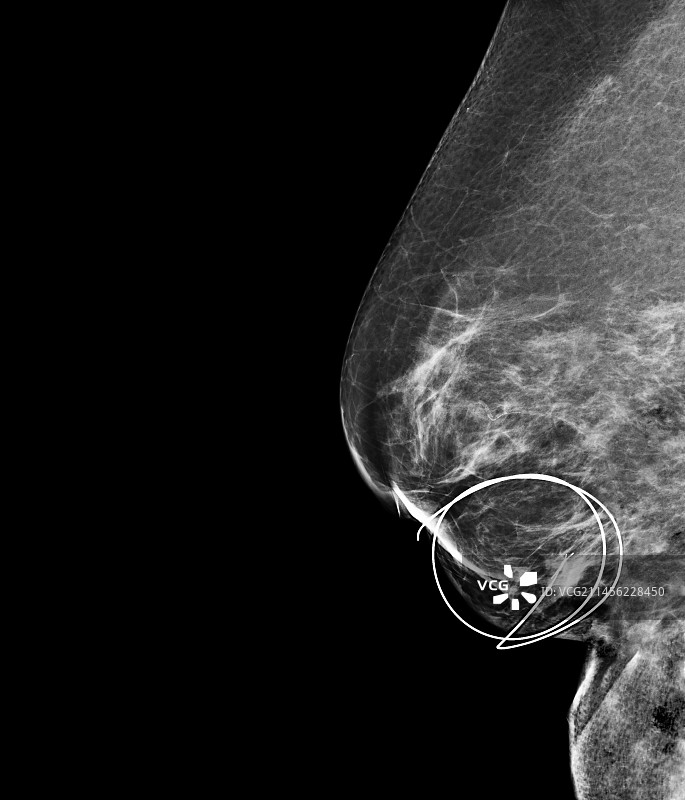 乳腺癌手术的乳房X光照片图片素材