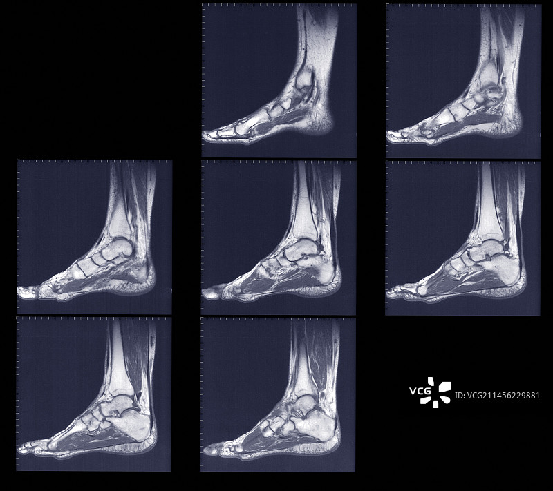 足部和踝部侧面扫描，MRI图片素材