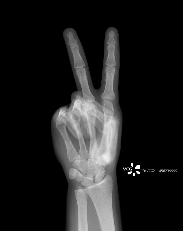 和平手势X光图片素材