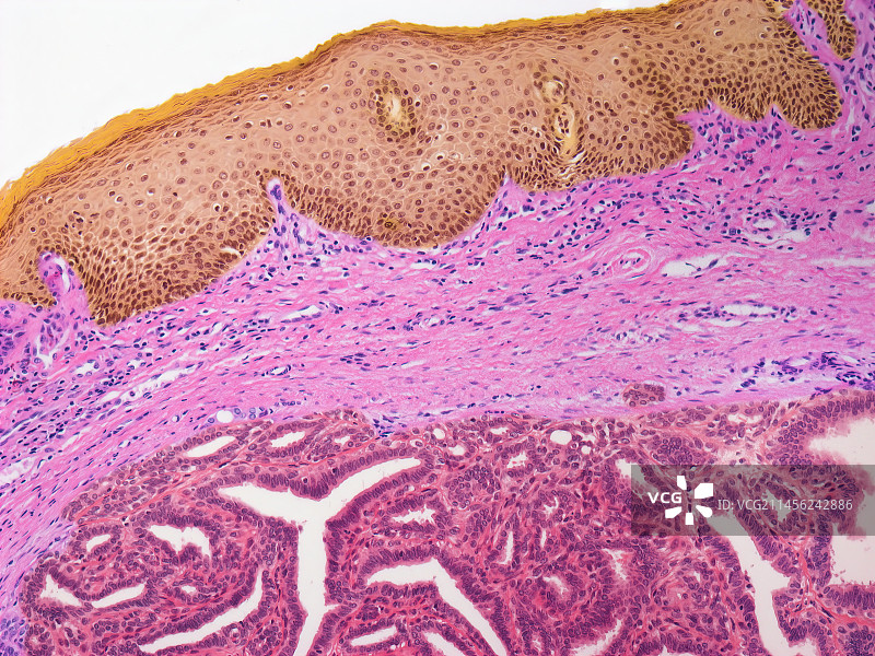 乳头状汗腺瘤光镜图像图片素材