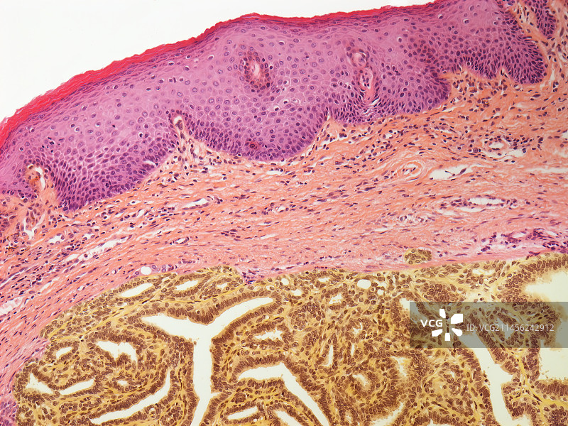乳头状汗腺瘤光镜图像图片素材