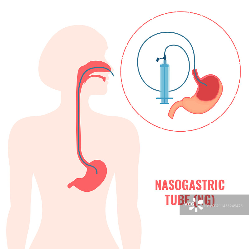鼻饲管插图图片素材