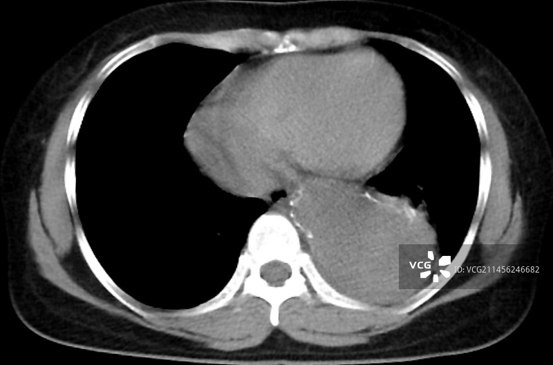 主动脉动脉瘤CT扫描图片素材