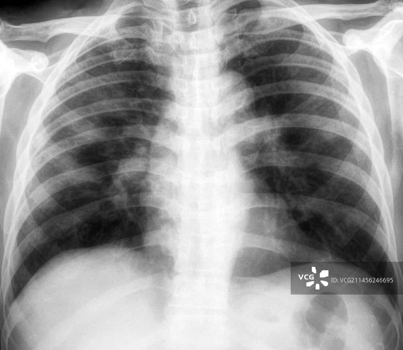 新冠肺炎X光片图片素材