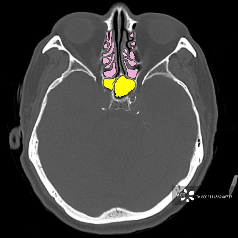 鼻窦解剖，CT扫描图片素材