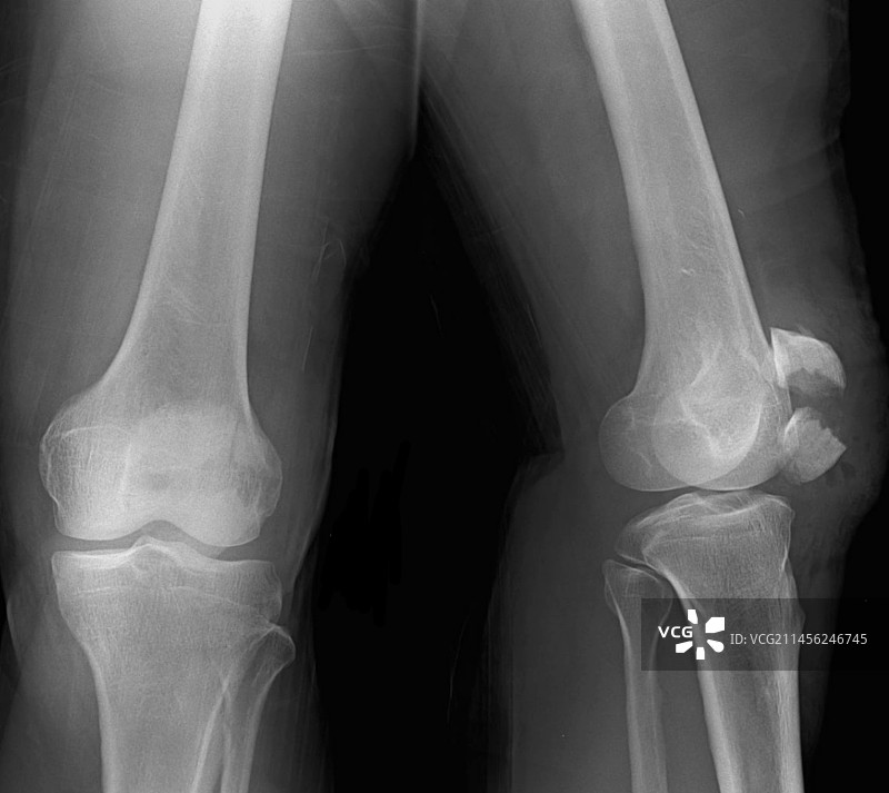 膝盖骨折X光片图片素材
