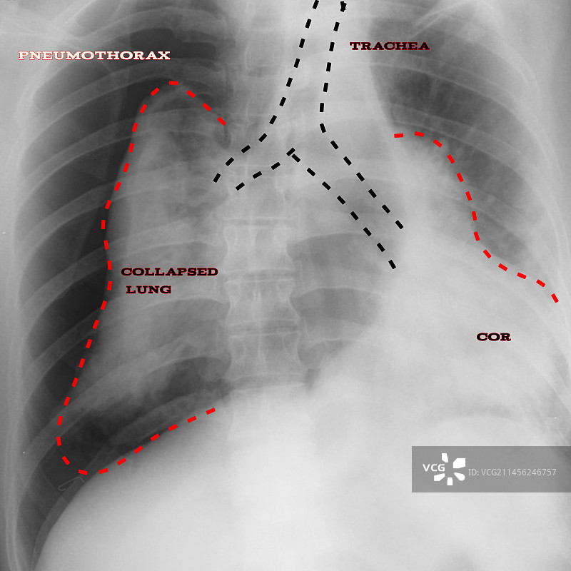 气胸X光片图片素材