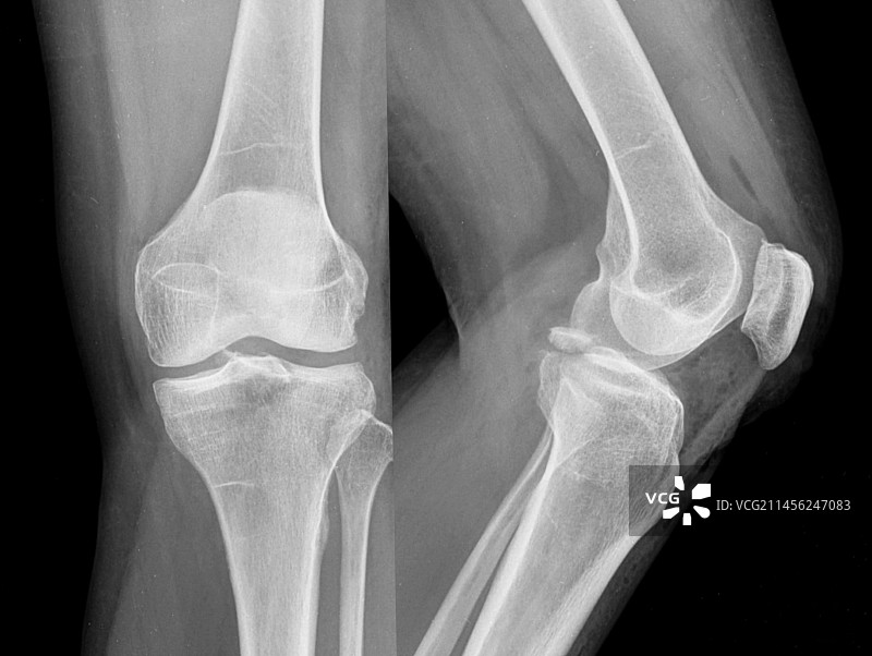 后十字韧带撕脱性骨折X光片图片素材