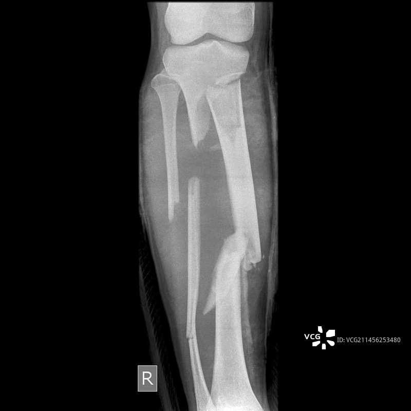 腿部骨折X光片图片素材