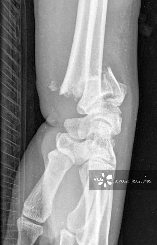 科莱斯骨折X光片图片素材