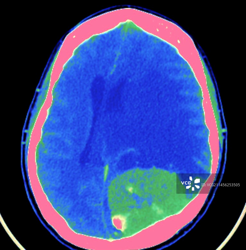 脑膜瘤CT扫描图片素材