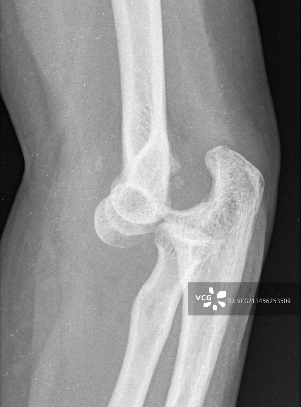 肘关节脱位X光片图片素材