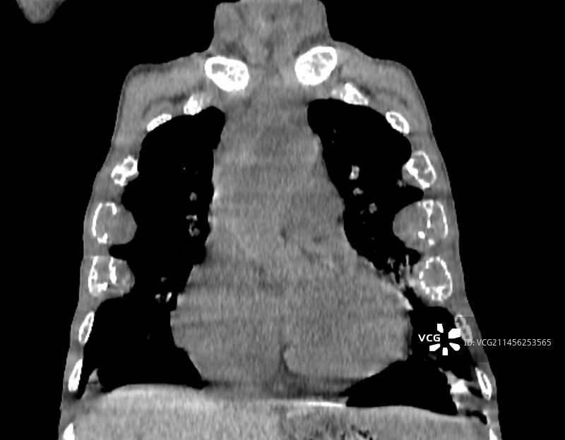 髓外造血CT扫描图片素材