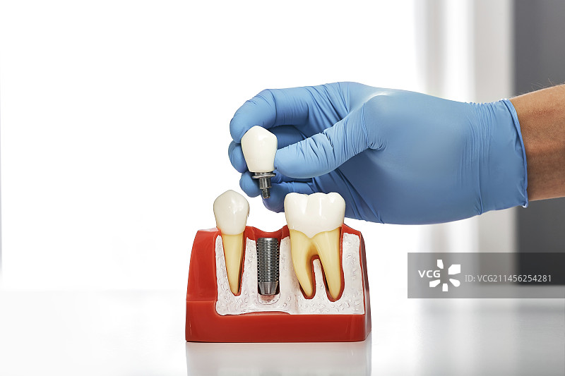 牙科植入物模型图片素材