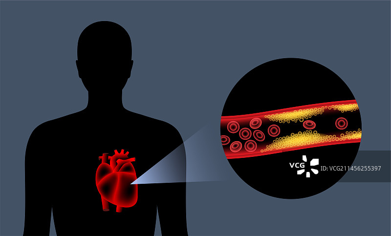 动脉粥样硬化示意图图片素材
