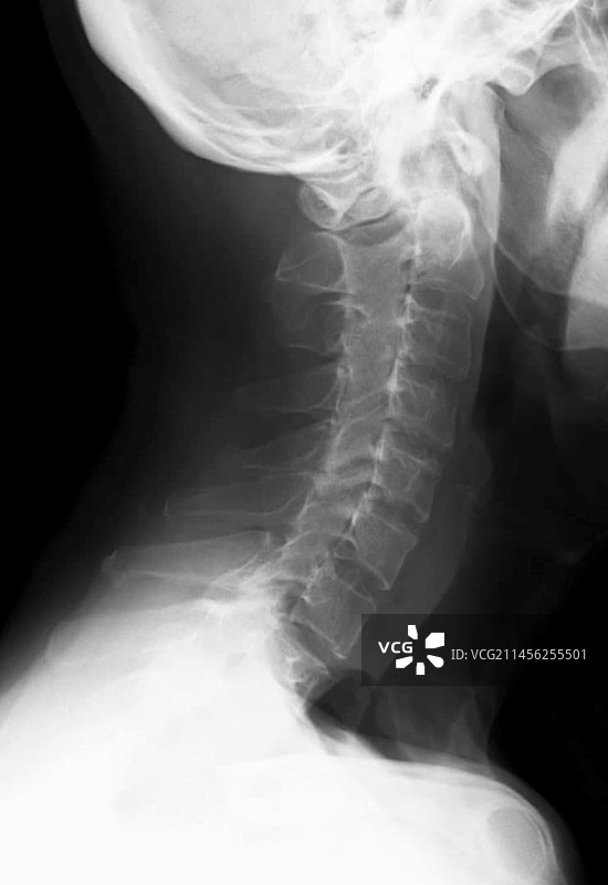 小关节强直的X光片图片素材