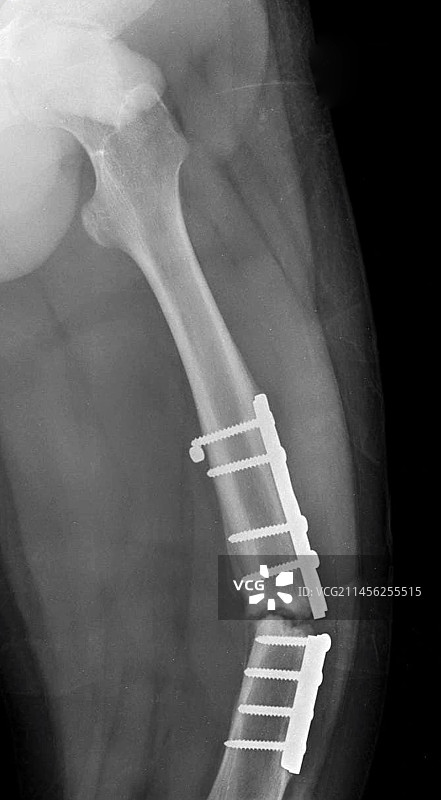 股骨骨折和断裂钢板X光片图片素材