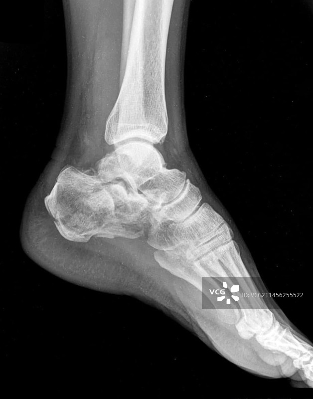 足跟骨折X光片图片素材