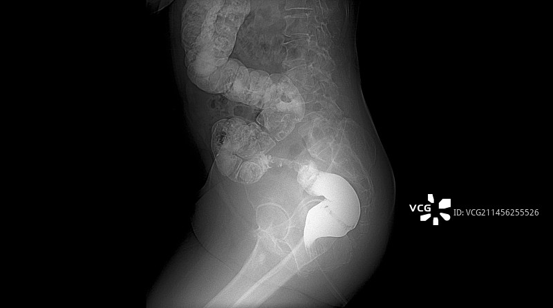 结直肠癌X光片图片素材
