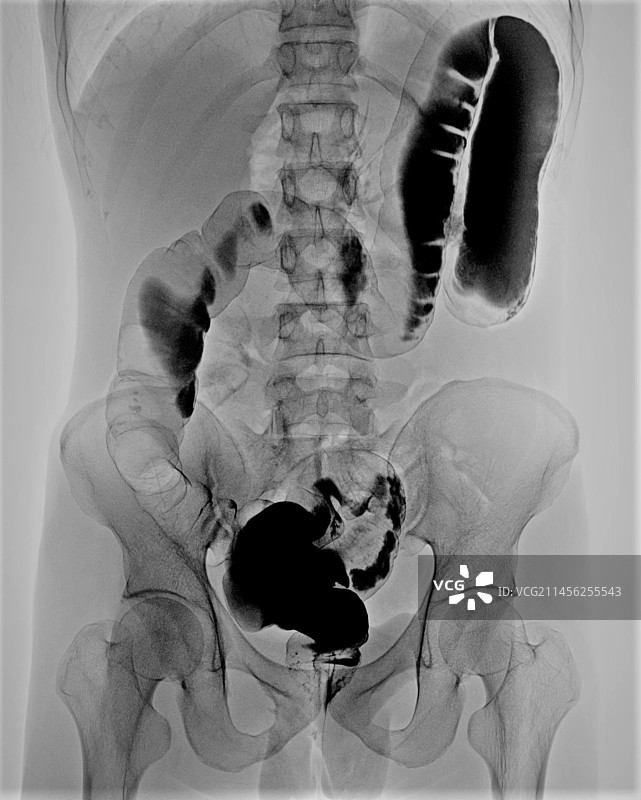 结肠旋转不良X光片图片素材