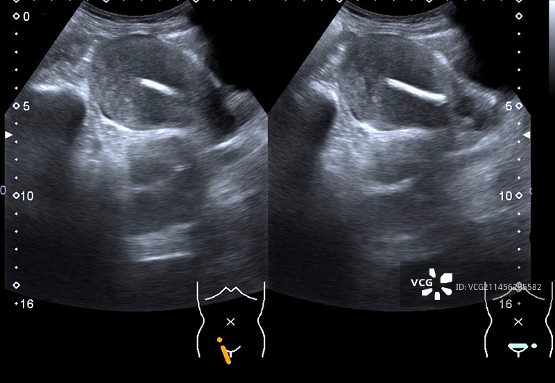 宫内节育器超声波扫描图片素材