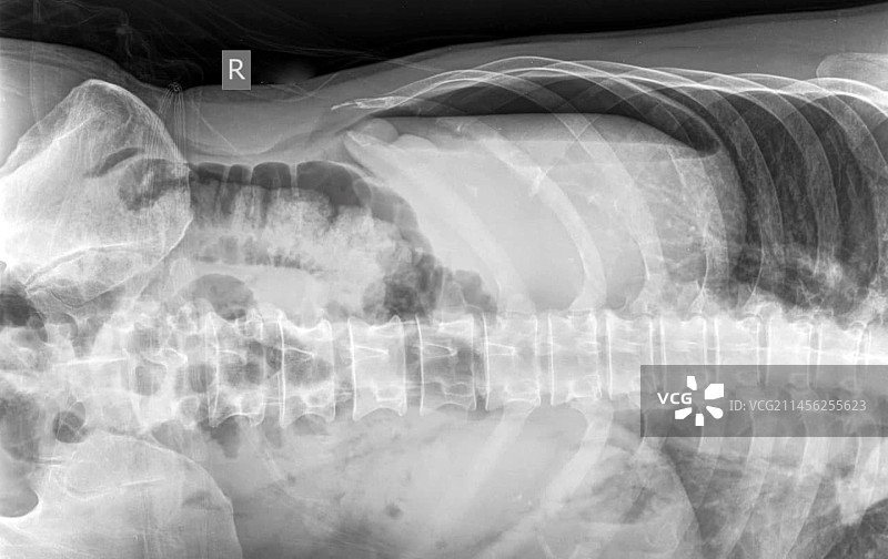 气腹X光片图片素材