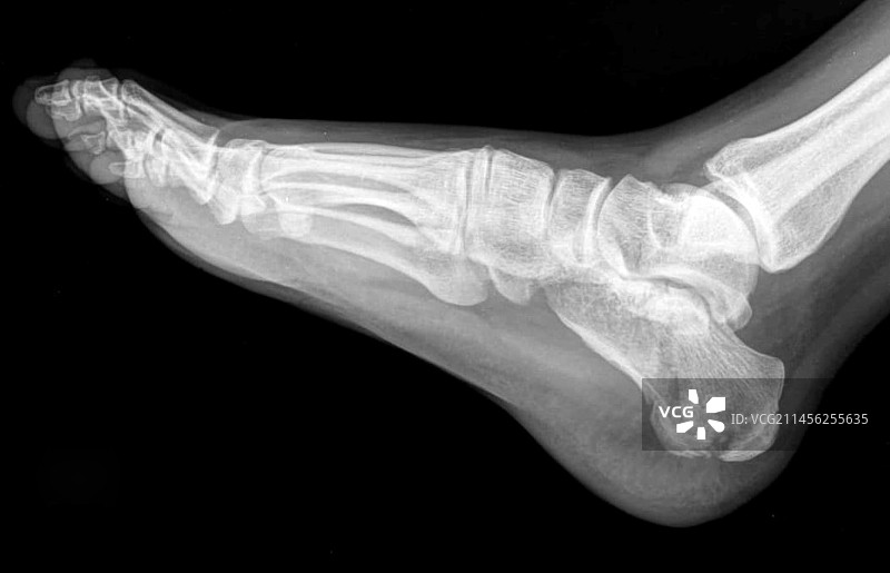 跟骨骨折X光片图片素材