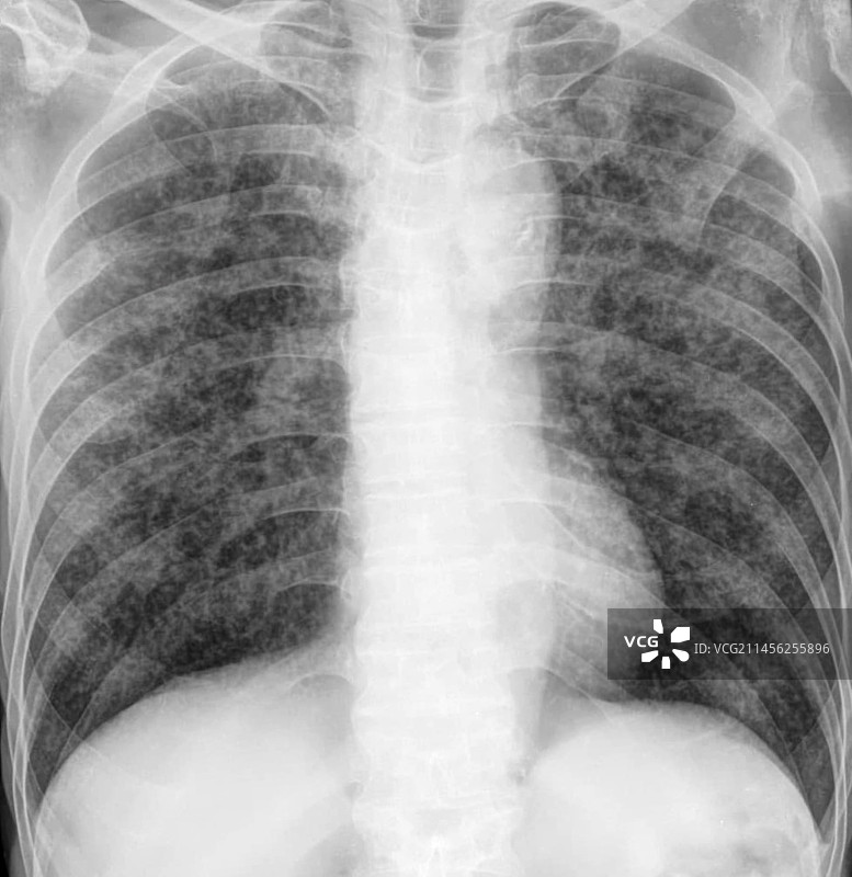 粟粒结节X光片图片素材
